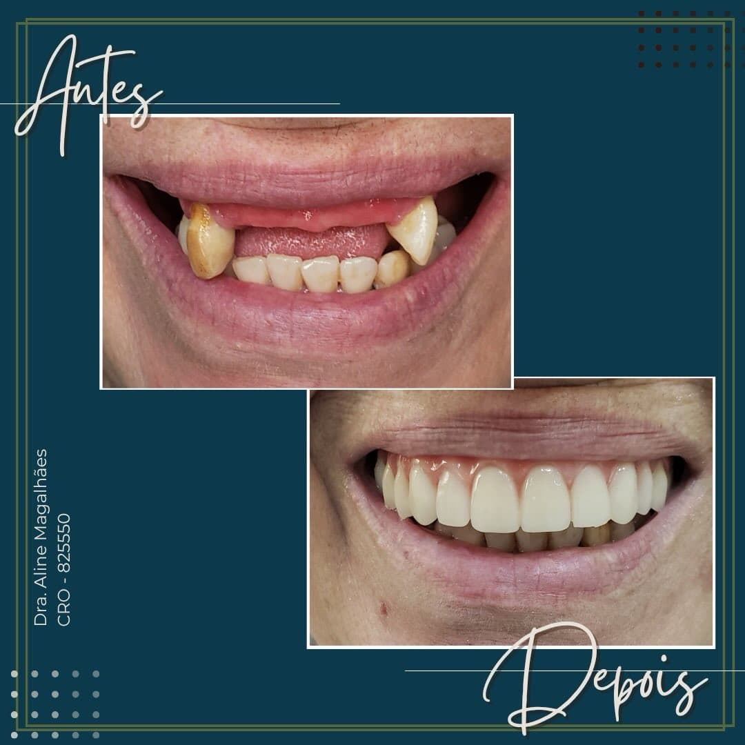 Depois — Resultado real